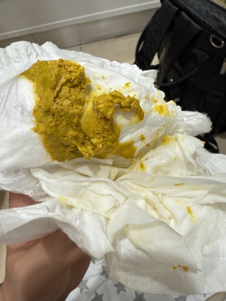 Unusual baby poo