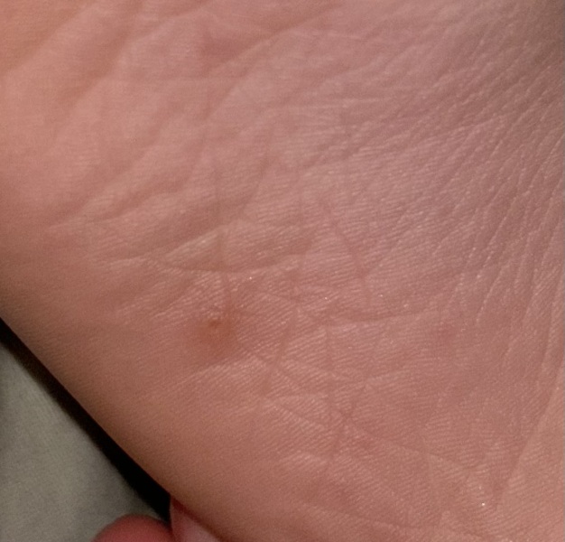 HFM?