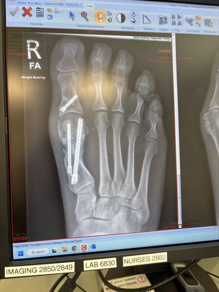 How the hell to cope with bunions?!