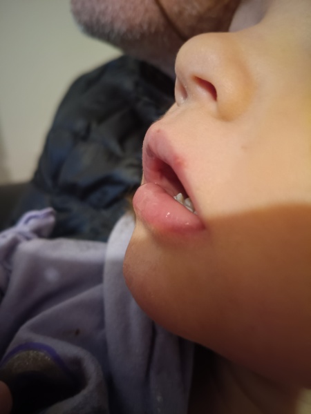 Desogestrel mini pill