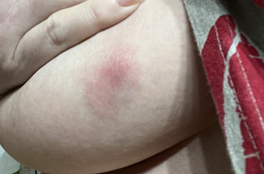 Bite or abscess?