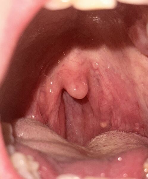 Mouth lump