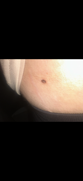 Mole or skin tag