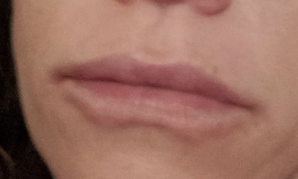 Do You Have Lip Fillers?