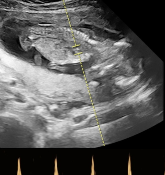 private 15 week scan- worried about spinal bifida