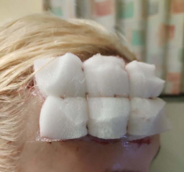 Daughter in hospital - full thickness burns