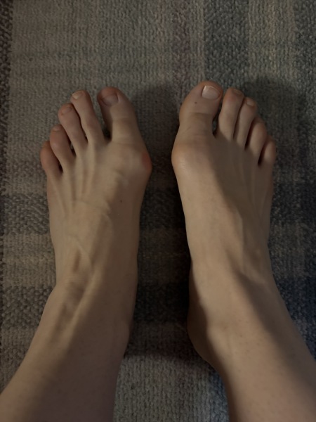 How the hell to cope with bunions?!