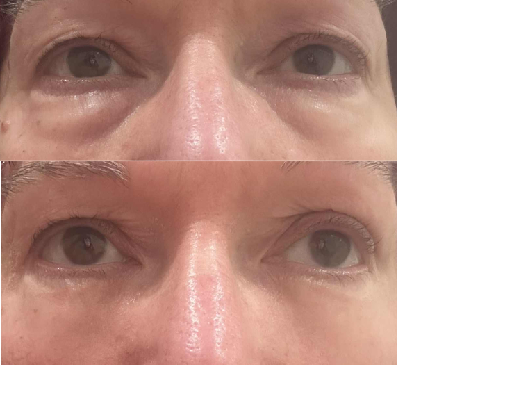 Under eye hollows- help!