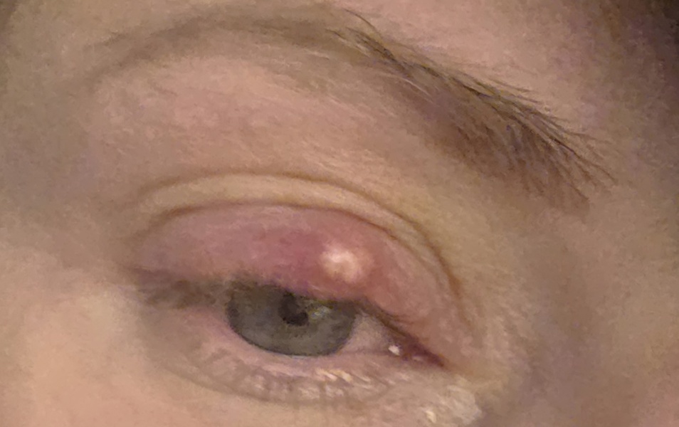 Large stye - how to encourage it to pop/reduce?