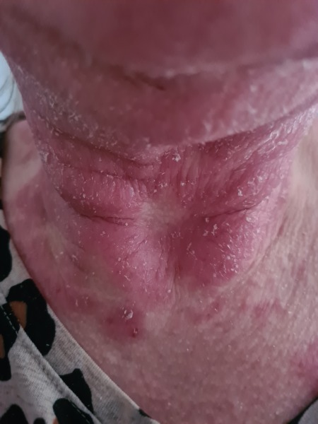 How would you feel? Severe eczema flare-up [pic included]