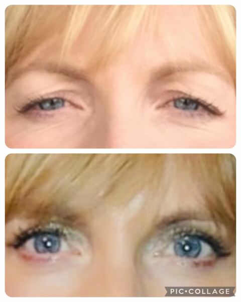 I’m thinking of blepharoplasty.