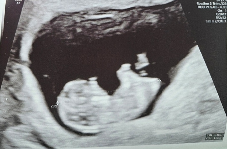 Struggling to conceive after MMC