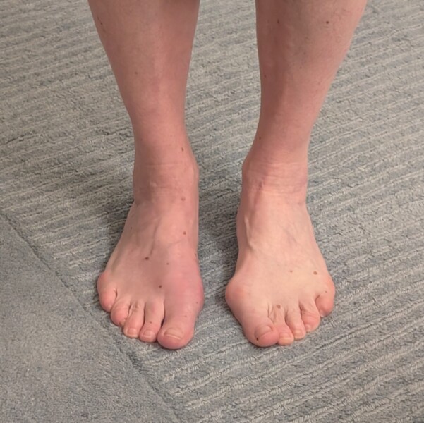 How the hell to cope with bunions?!