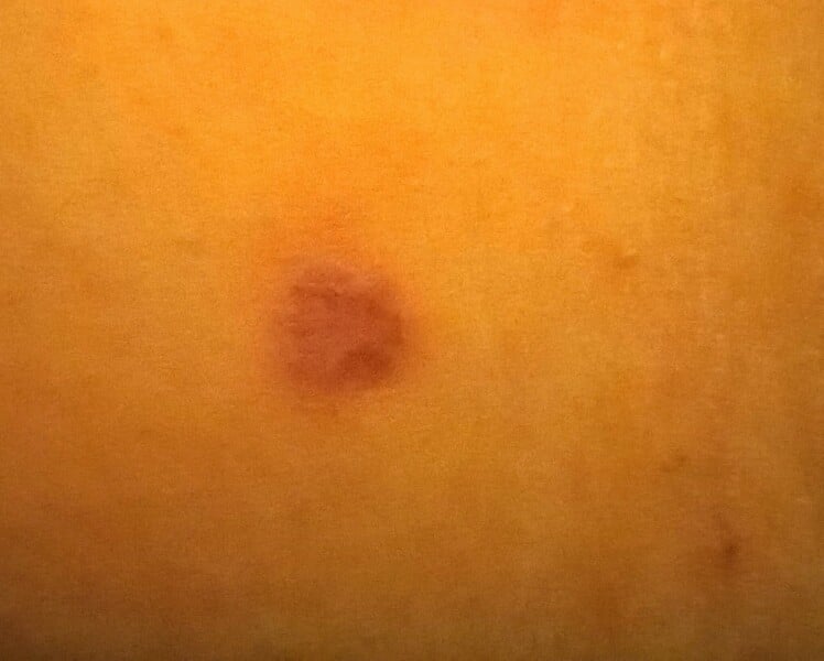 Any dermatologists here? Df thinks I may have skin cancer?