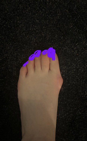 How the hell to cope with bunions?!