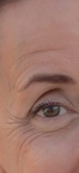 I’m thinking of blepharoplasty.