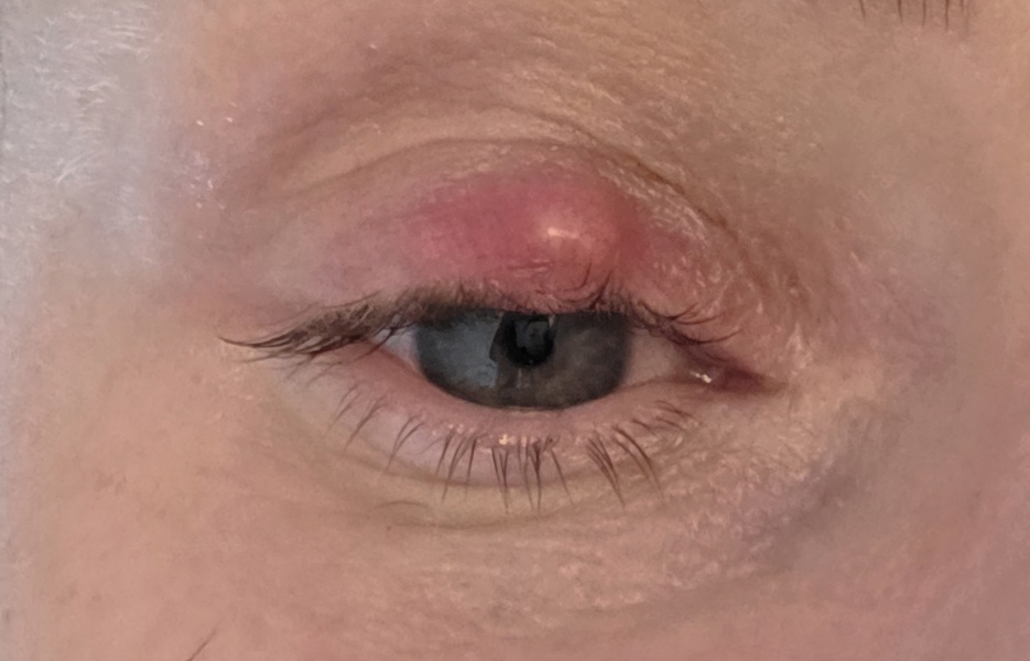 Large stye - how to encourage it to pop/reduce?