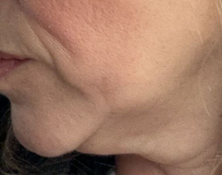 What to about these jowls?