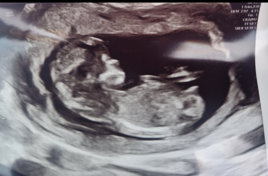 20 week gender scan