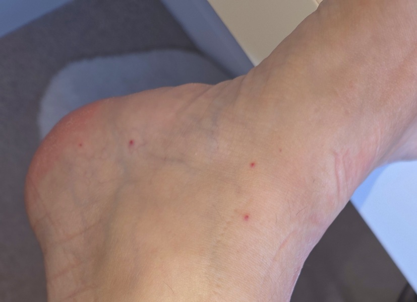 How common is a rash in/after covid?