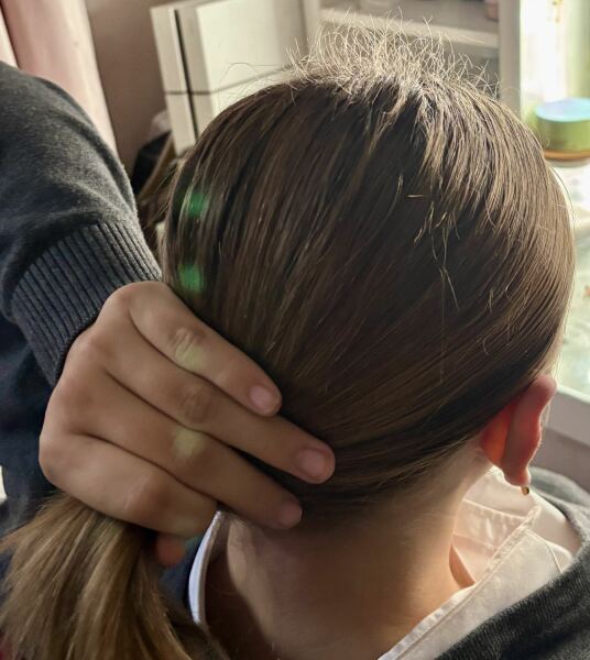 Hair breakage - thyroid issues