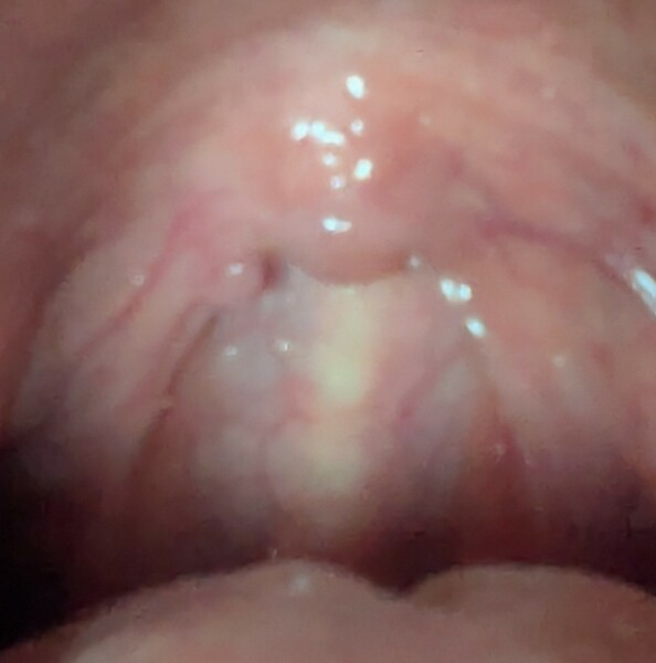 What is this in my throat?
