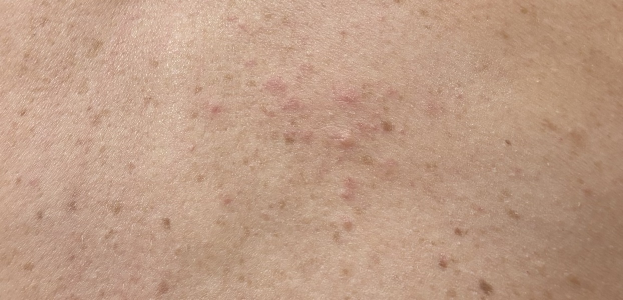 Shingles??