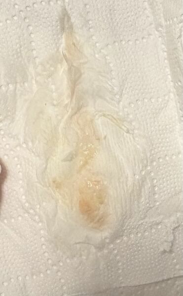 TW*/TMI PICS. Could this be implantation bleeding?
