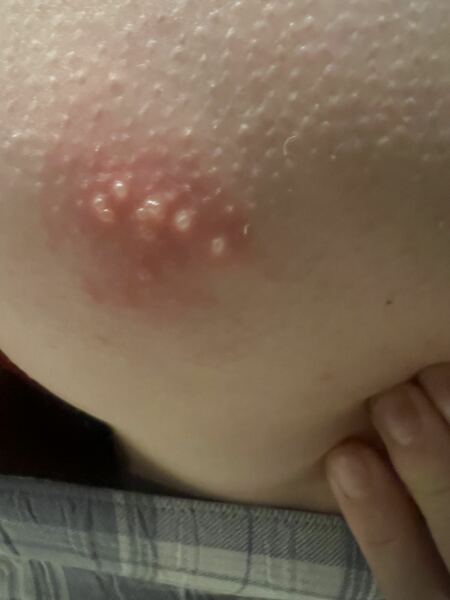 Shingles??
