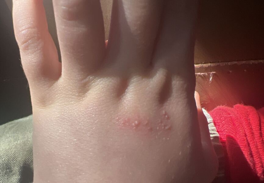 Is this HFM or Chicken Pox?