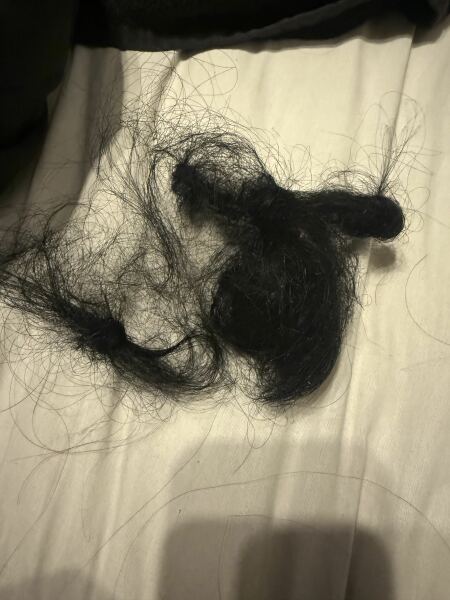 Hair loss on Mounjaro