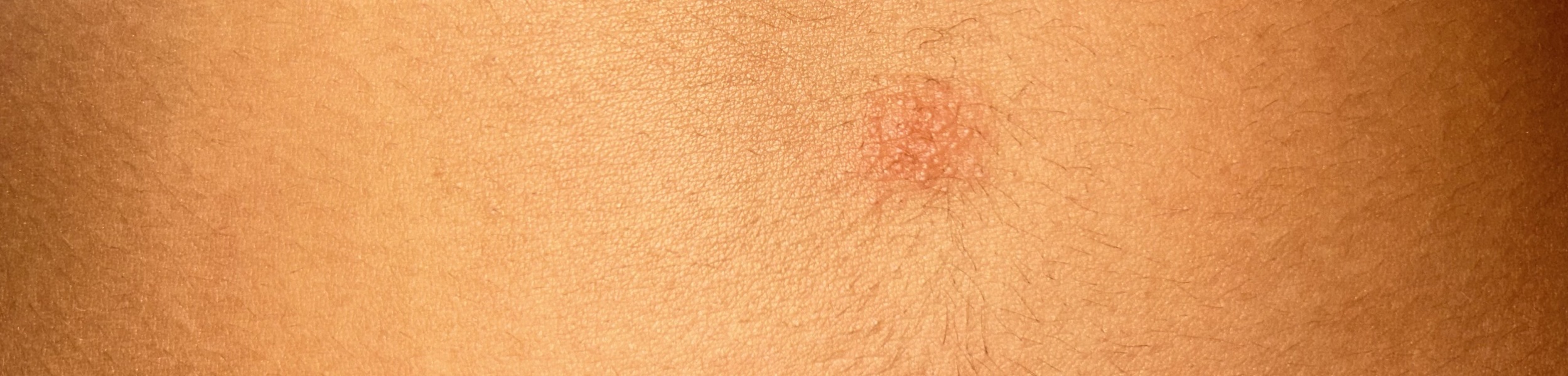 Rash / red mark on stomach