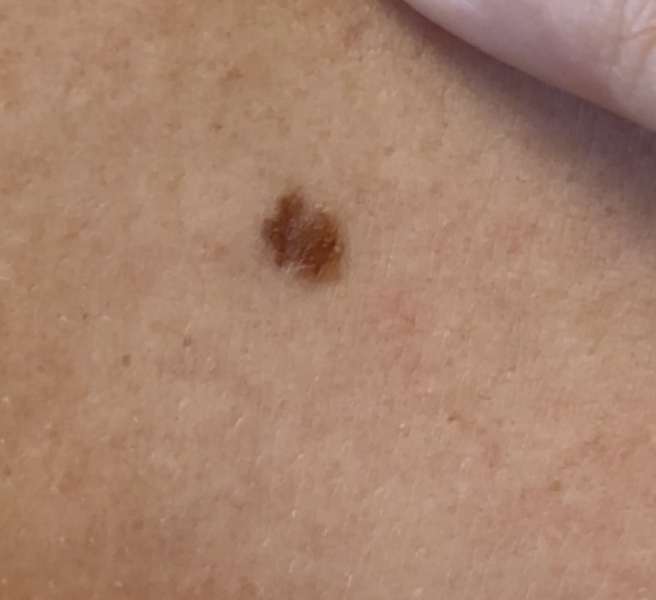 Does this mole look irregular