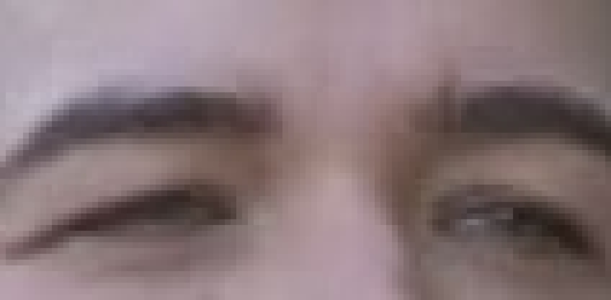 Blepharoplasty on NHS?