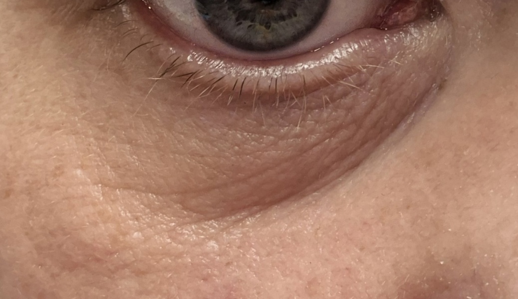 Tear trough filler, whats your experience?