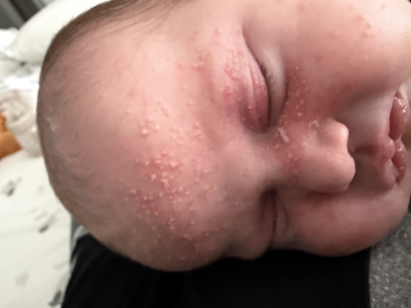 Baby Acne