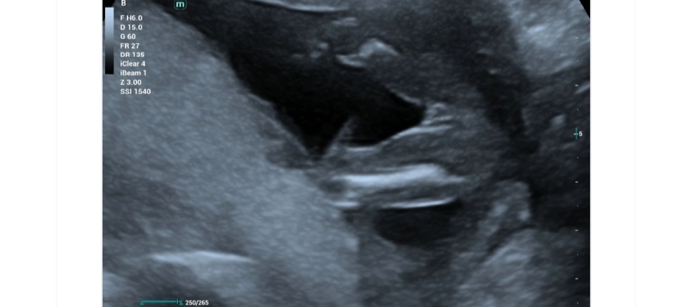 17 week scan, girl or boy?