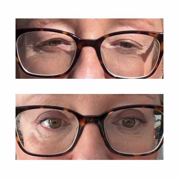 Make up help after upper bleph