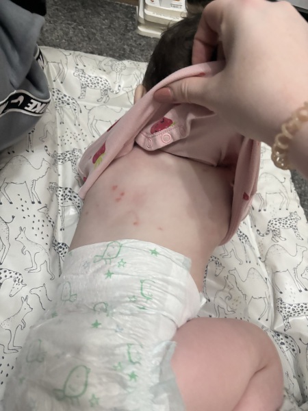 Red marks under baby skin