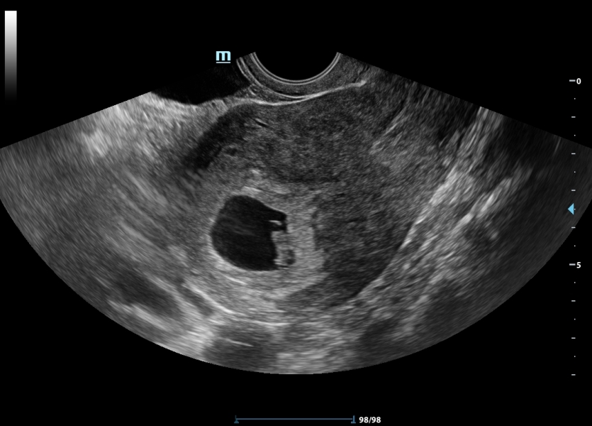 6 week scan but measuring less should I be worried?