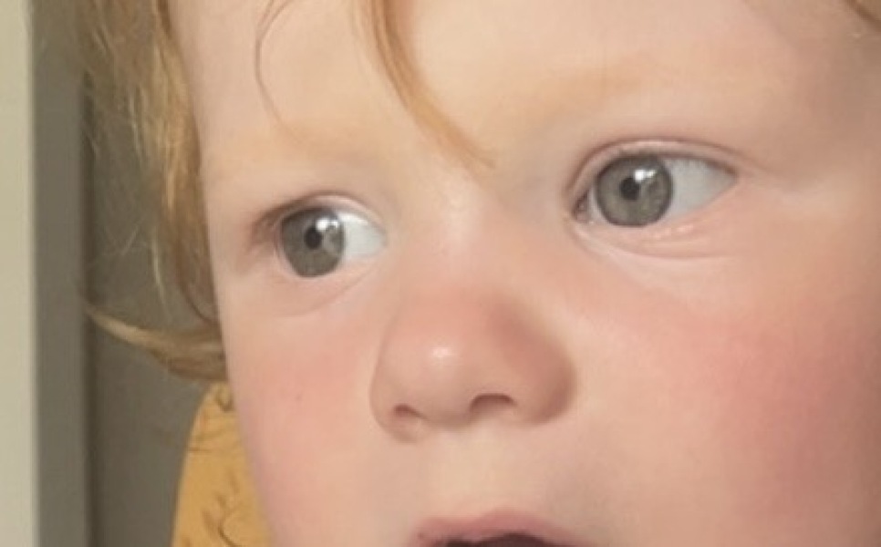 Lines/folds under baby's eye? Picture attached