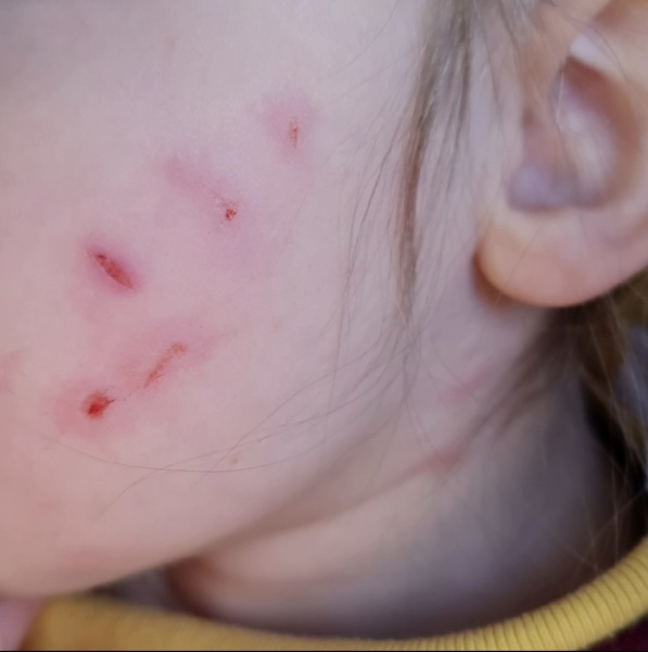 Autistic child attacking DD part 2