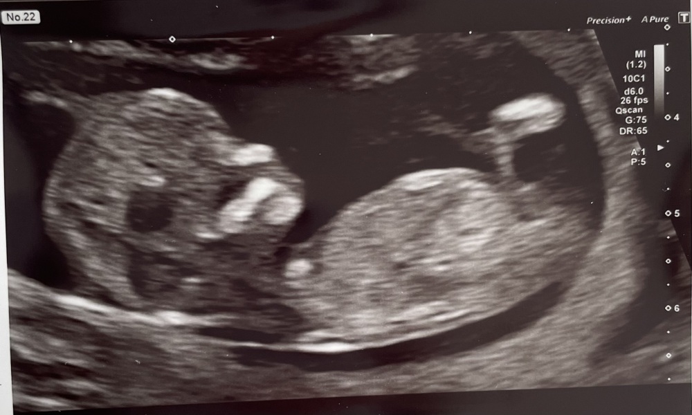Gender guesses from 12 week scan? Just for FUN!