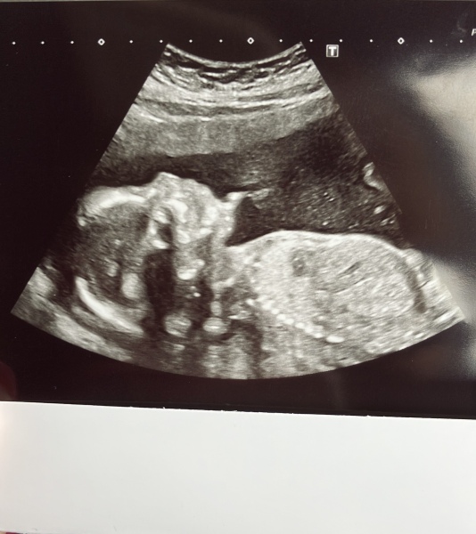 Boy or girl guesses 🤍