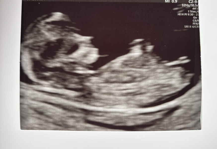 12 week scan