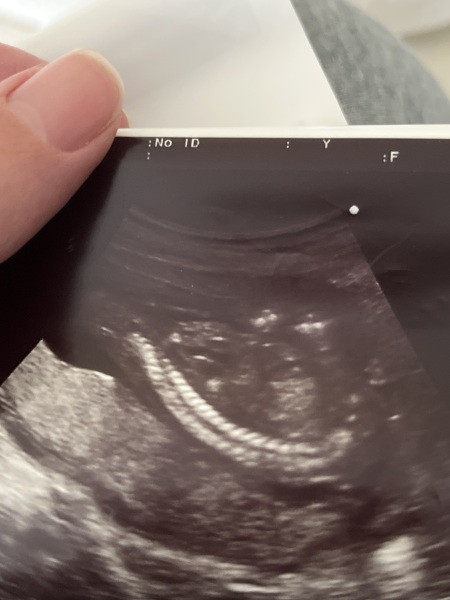 private 15 week scan- worried about spinal bifida