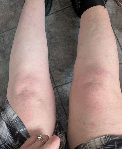 Is this significant leg swelling?