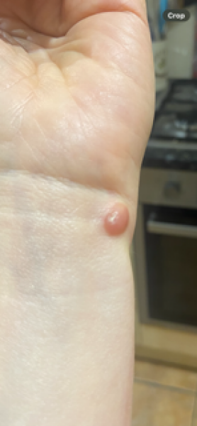 Urgent referral - suspected basal cell carcinoma