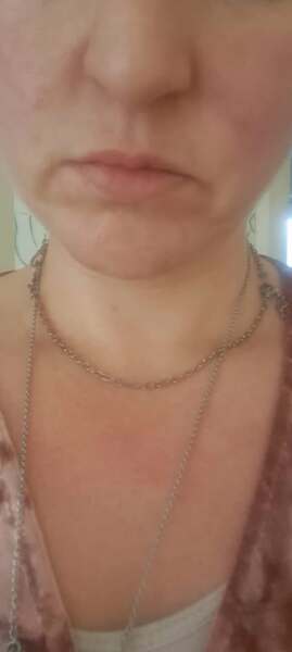 If you've had your lips plumped ...
