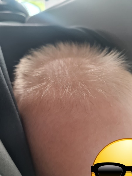 Uncombable hair syndrome or overthinking it??